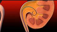 Ureteral Obstruction - Retrograde insertion of Resonance stent