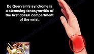 De Quervain's Syndrome - Everything You Need To Know - Dr. Nabil Ebraheim