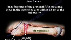 Jones Fracture,proximal fifth metatarsal - Everything You Need To Know - Dr. Nabil Ebraheim
