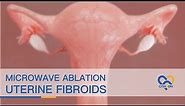 Microwave Ablation of Uterine Fibroids - Animation