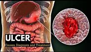 Ulcer, Causes, Signs and Symptoms, Diagnosis and Treatment.