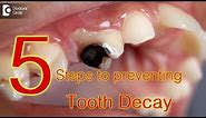 5 Steps to preventing tooth decay - Dr. Gopathi Haritha