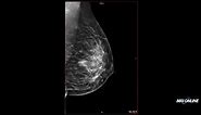 Using Mammography, Tomosynthesis, and Ultrasound in Breast Imaging
