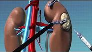 The Kidney and Kidney Cancers | UCLA Urology