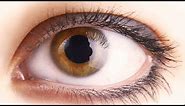 How to treat white bump on eye corner at home? - Dr. Nischal K