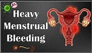 What Causes Heavy Menstrual Bleeding (Menorrhagia) |Causes Of Heavy Menstrual Bleeding