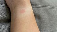 Why Do I Get A Rash After Wearing My Apple Watch ? - DeviceMAG