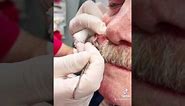 Pebble like Cyst Drained Las Vegas Dermatology