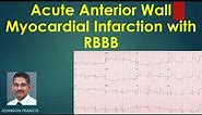 Acute Anterior Wall Myocardial Infarction with RBBB