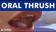 ORAL THRUSH - Candidiasis or yeast infection. Angular cheilitis ©