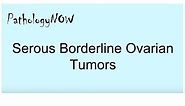 Pathology of Serous Borderline Ovarian Tumors