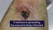 How To Recognize and Treat an Infected Cut, Burn, or Abrasion