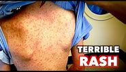TERRIBLE Full Body Rash | Dr. Paul