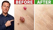 Dr. Eric Berg - How to Rid Skin Tags and Warts OVERNIGHT...