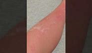 Skin Peeling from Sunburn #asmr