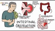 Intestinal Obstruction - Small Bowel Obstruction vs Large Bowel Obstruction