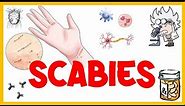 Scabies :- Life Cycle, Pathogenesis, Types, Signs & Symptoms, Risk Factors, Diagnosis & Treatment