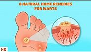 8 Surprising Home Remedies for Warts - Get Rid of Them Naturally!