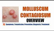 Molluscum Contagiosum (Water warts)- Symptoms, transmission, prevention, diagnosis, treatment