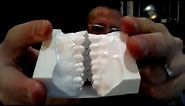 Dental Appliance for Sleep Apnea