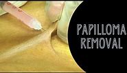 Benign Papilloma removal