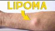 Lump or bumps underneath the skin? Benign Mesenchymal Lipoma