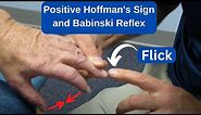 Positive Hoffman's Sign and Babinski Reflex in an MS Patient