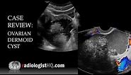 Case Review: Ultrasound of Ovarian Dermoid Cyst