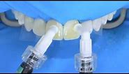 Fluorosis treatment using Icon infiltration, step by step