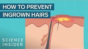 What Are Ingrown Hairs — And How To Treat Them