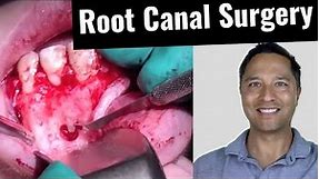 Root Canal Surgery (Apicoectomy)