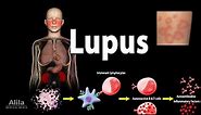 Lupus: Symptoms, Risk factors, Pathophysiology, Diagnosis and Treatments.
