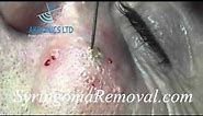 Syringoma Removal using ElectroFulguration
