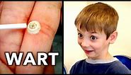 FREEZING OFF A BIG FINGER WART (This Kid is Really Brave) | Dr. Paul