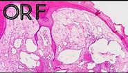 Orf (ecthyma contagiosum/skin virus disease from sheep) pathology dermpath dermatology