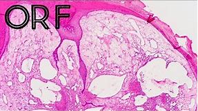 Orf (ecthyma contagiosum/skin virus disease from sheep) pathology dermpath dermatology