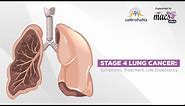 Stage 4 Lung Cancer: Symptoms, Treatment. Life Expectancy | Episode 22