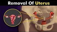 What happens in hysterectomy? Uterus Removal surgery animation