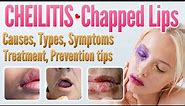 Cheilitis Causes, Symptoms, Types, Risk Factors, Treatment, Prevention, Home remedies | Chapped Lips