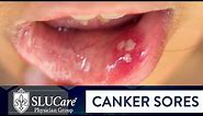 Determining Causes & Treatment for Canker Sores - SLUCare Otolaryngology
