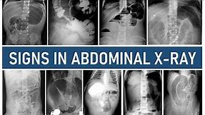 Signs in Abdominal X-ray