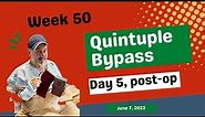 Week 50 Quintuple Bypass surgery
