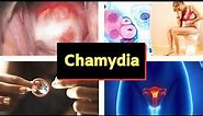 Chlamydia pictures - Causes Signs Symptoms Treatment images and Photos of chlamydia