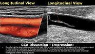 Carotid Artery Doppler Ultrasound Reporting | How To Write USG Report | Stenosis USG Scan Reports