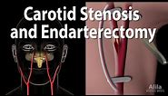 Carotid Stenosis and Carotid Endarterectomy, Animation