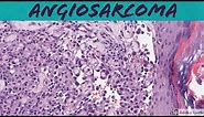Angiosarcoma: 5-Minute Pathology Pearls