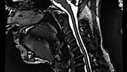 Realtime MRI of Cervical Spine