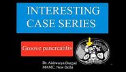 GROOVE PANCREATITIS | Detailed CT case discussion | Differential diagnosis