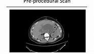 Image-Guided Percutaneous Drainage of Abnormal Abscesses and Fluid