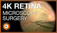 4K UHD Ophthalmic Retina Microscope Surgery Highlights